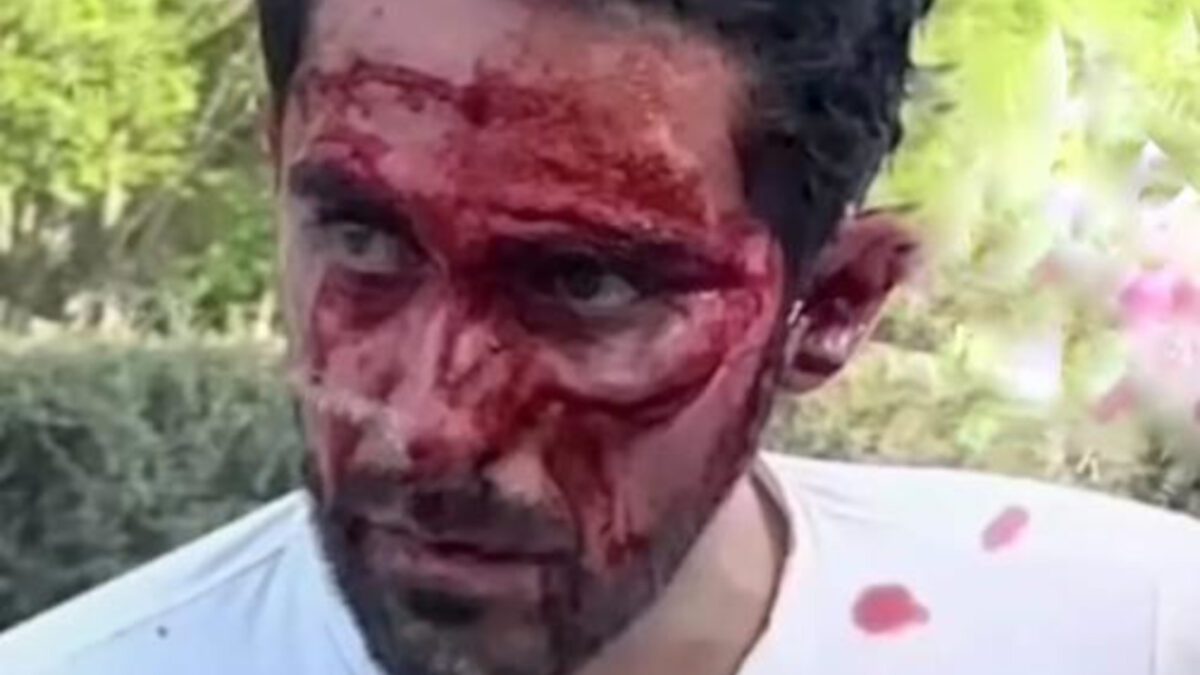 Alberto Contador's smashed face